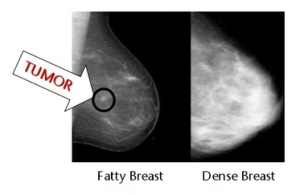 dense breast